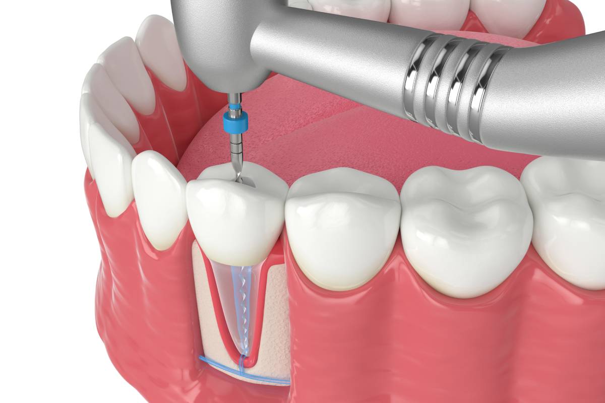 Devitalizzazione Dente